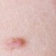 What Causes Skin Tags to Appear